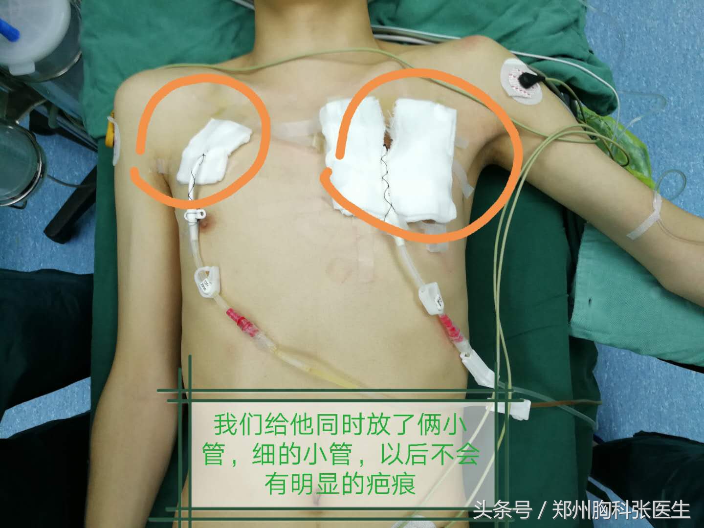 气胸怎么给医生说,专家讲气胸