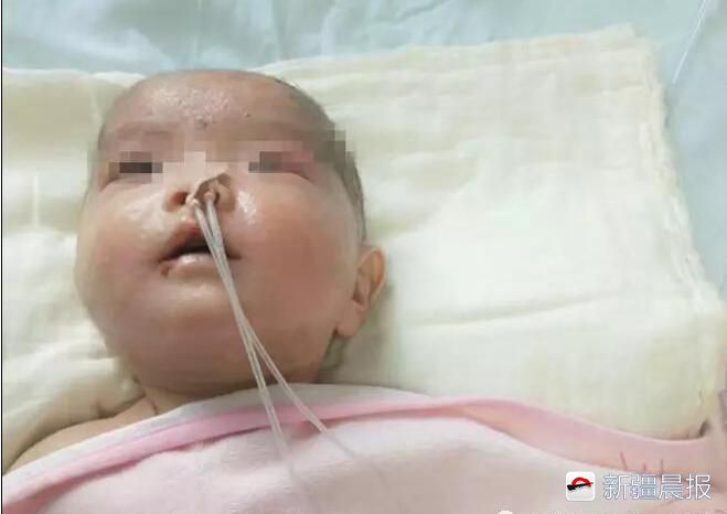 宝宝长水痘什么情况下住院治疗,40天的宝宝刚得水痘吃药控制住吗