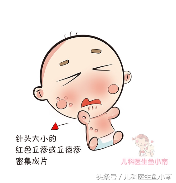 宝宝湿疹和热疹的区别和护理,宝宝湿疹和热疹怎么区分如何护理