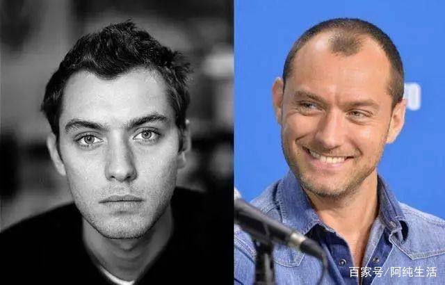 别让秃头误了你的颜值,不要让发际线毁了