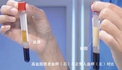 血脂高会引起血栓脑梗吗,高脂血症为什么会引起血栓