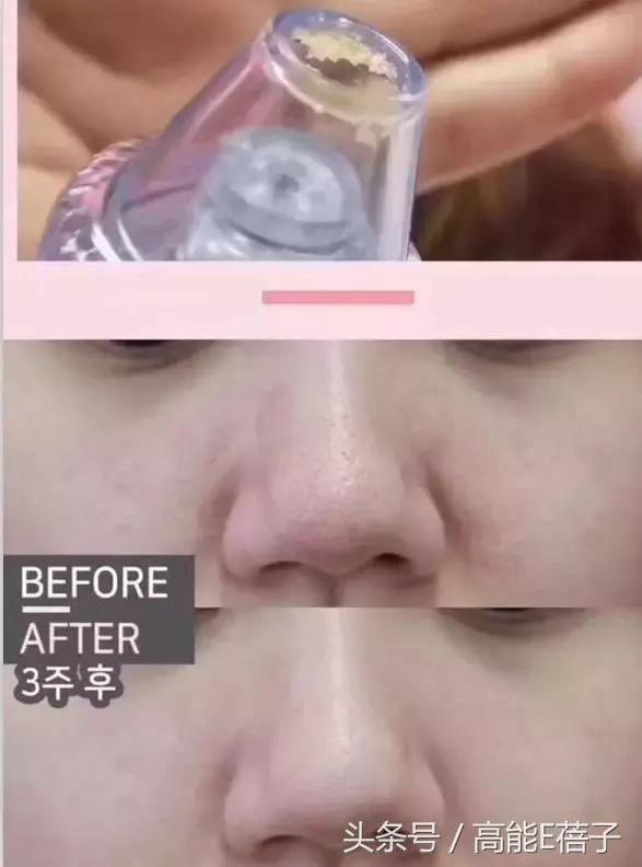 别傻了！蔡徐坤、Angelababy都根治不掉的黑头，微商神器能去除？