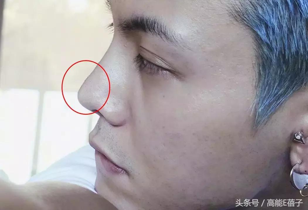 别傻了！蔡徐坤、Angelababy都根治不掉的黑头，微商神器能去除？