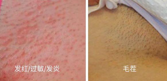 宫颈癌女性死前会有预感吗,平均两分钟有几个人死于宫颈癌