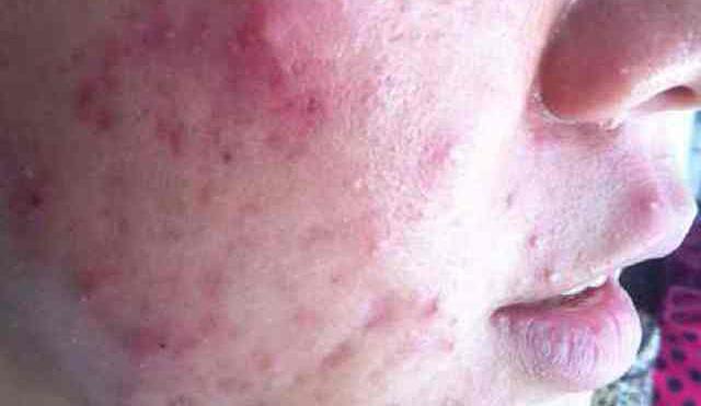 祛痘面膜真的可以祛痘吗,芙清祛痘面膜效果怎么样