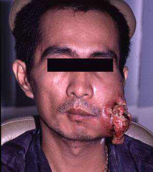 槟榔已被央视确认为一级致癌物,槟榔为何被称为一级致癌物