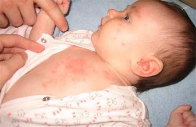 脂溢性皮炎和皮脂腺异位有关系吗,宝宝湿疹痤疮的区别