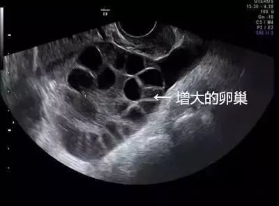 20岁女大学生捐卵事件18年,女大学生捐卵致富