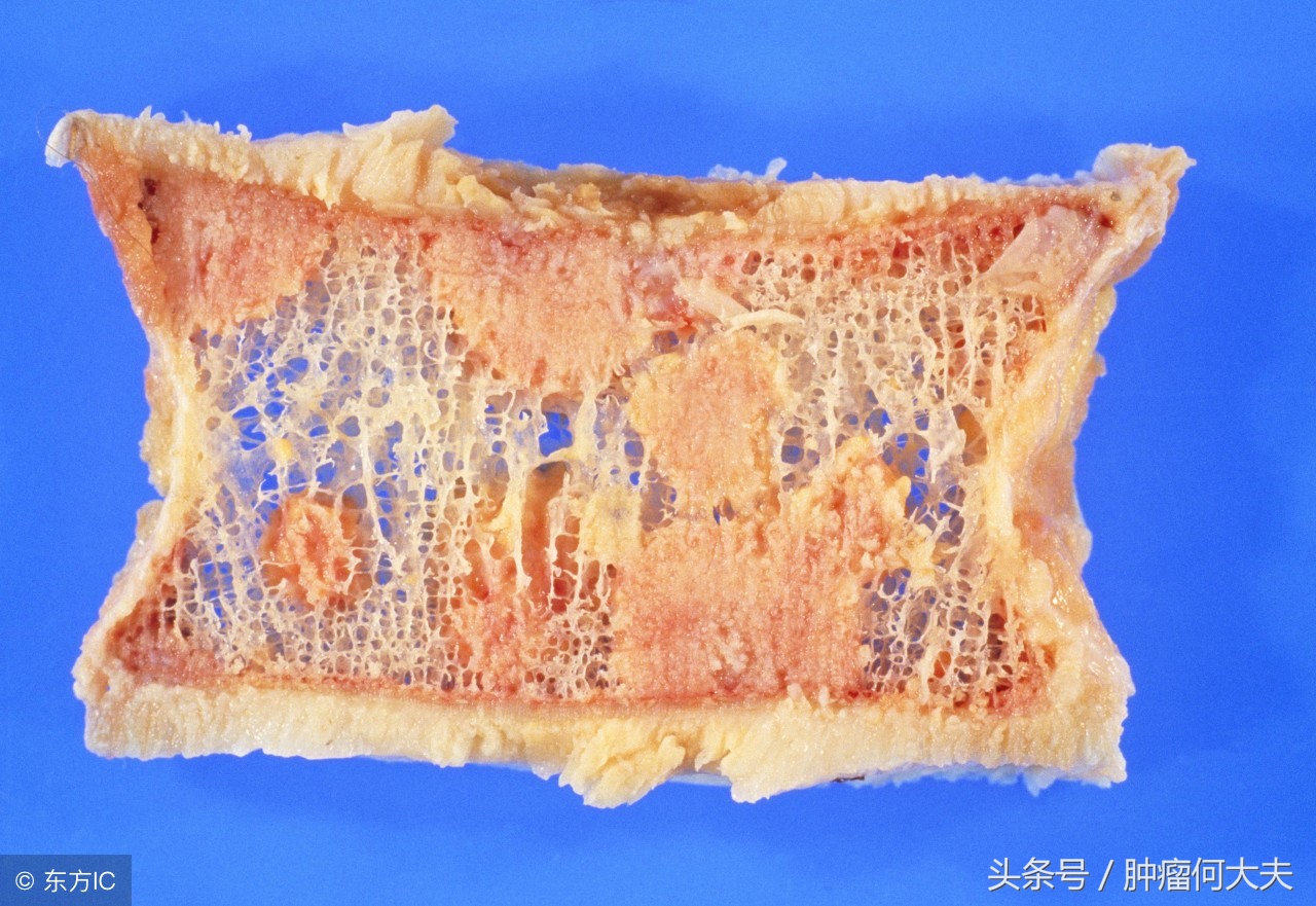 骨转移癌如何形成？治疗方法是什么？预后如何？