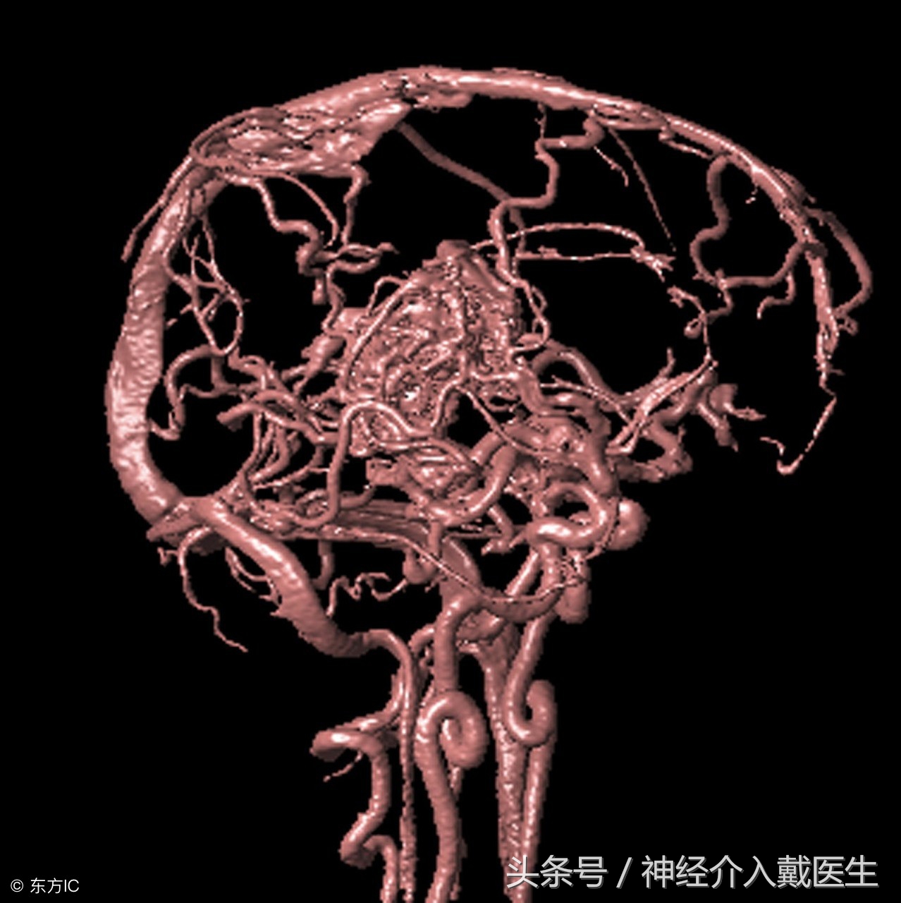 年轻人如何预防和缓解脑血管疾病,如何确诊脑血管疾病