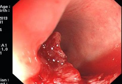 胃肠息肉手术多少钱,胃肠息肉的症状表现