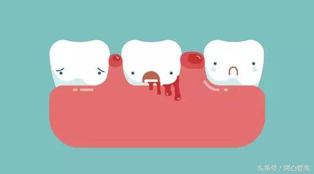 一刷牙就出血一吸牙也出血,刷牙容易出血平常口水也带血
