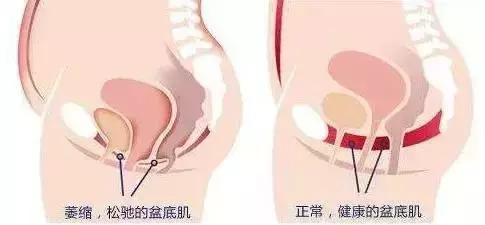 子宫脱垂、漏尿、腰痛、妇科病？当心！可能是你的盆底肌在作祟
