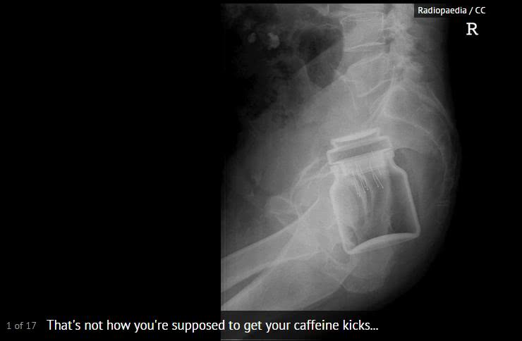 盘点X光透视下的人体异物,看着都痛!