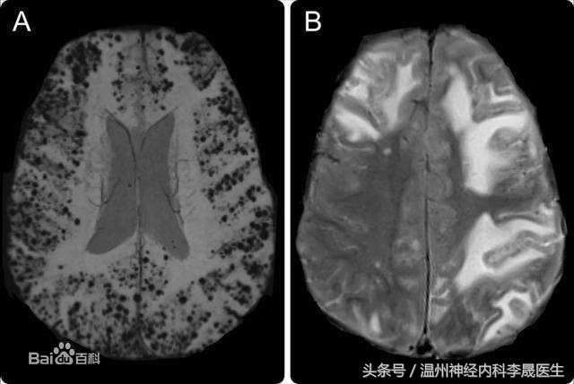 脑出血李医生,脑出血病例分析及答案