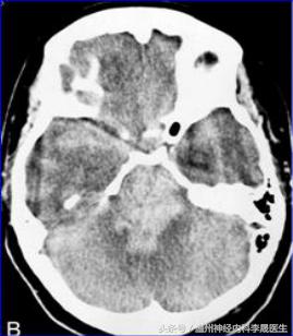 脑出血李医生,脑出血病例分析及答案