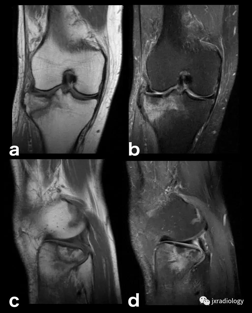 膝关节骨髓水肿疼痛特点,膝关节骨髓水肿的临床表现