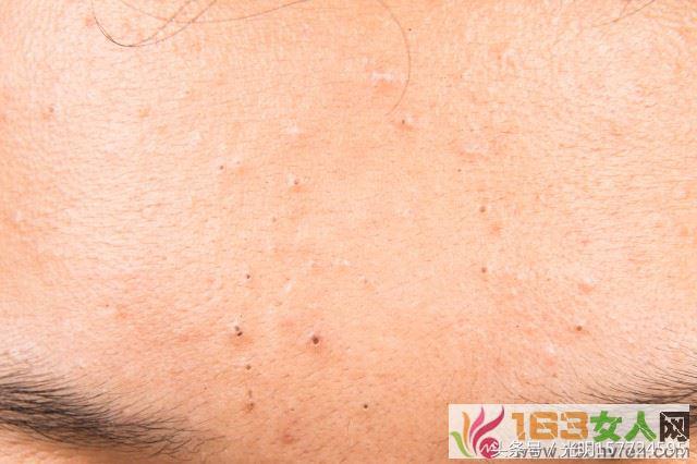 额头长痘的原因和调理方法,额头长痘怎么回事及调理方法