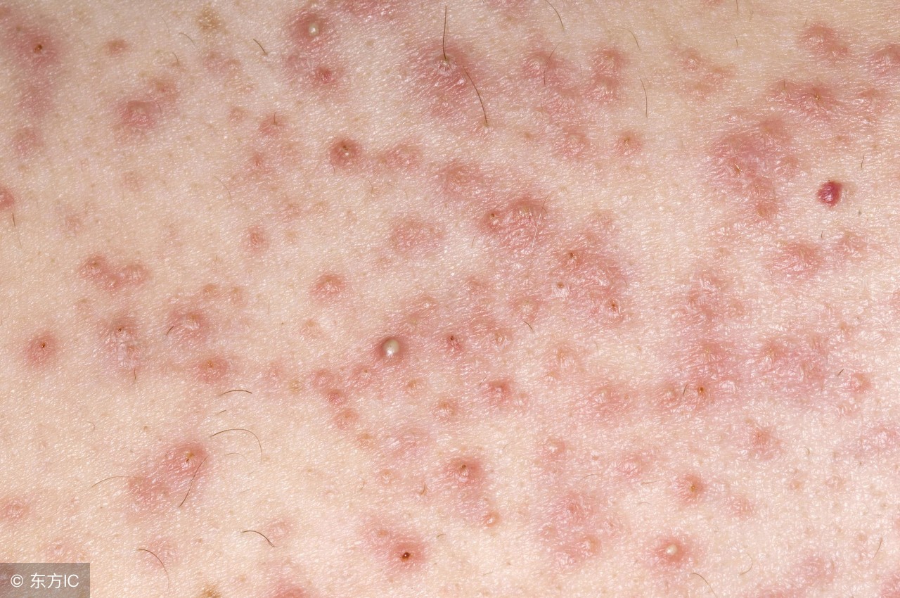 汗毛缩在毛囊里是怎么回事,汗毛蜷缩在毛囊里怎么办能治好吗