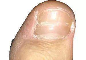 看指甲识健康,从指甲看疾病的图片说明