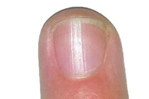 怎么从指甲上看健康图解,从指甲看疾病的图片说明