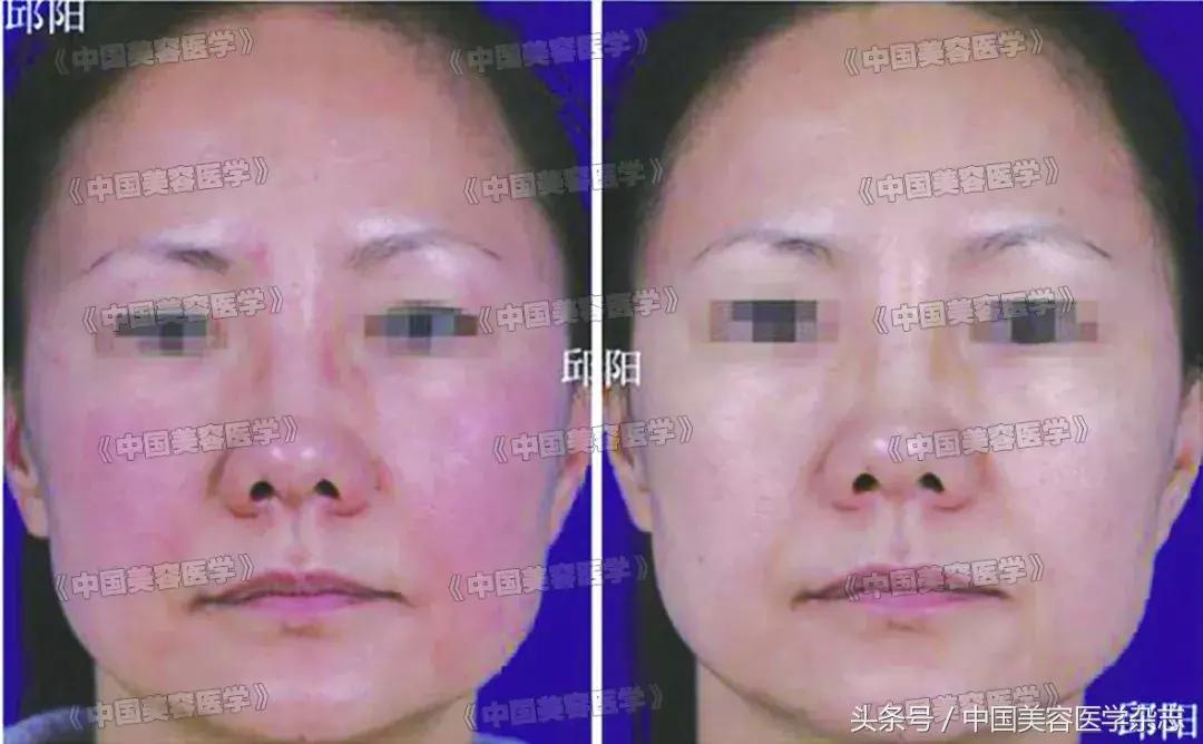 敏感肌脸泛红怎么治疗,敏感肌红脸蛋怎么改善