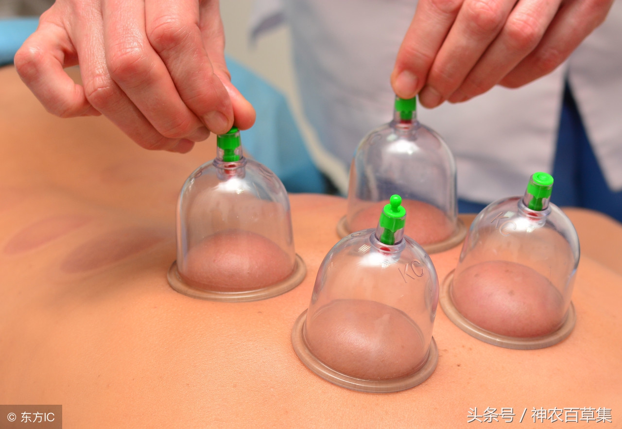 传统中医的常用疗法：拔罐，祛寒祛湿、疏通经络，建议收藏
