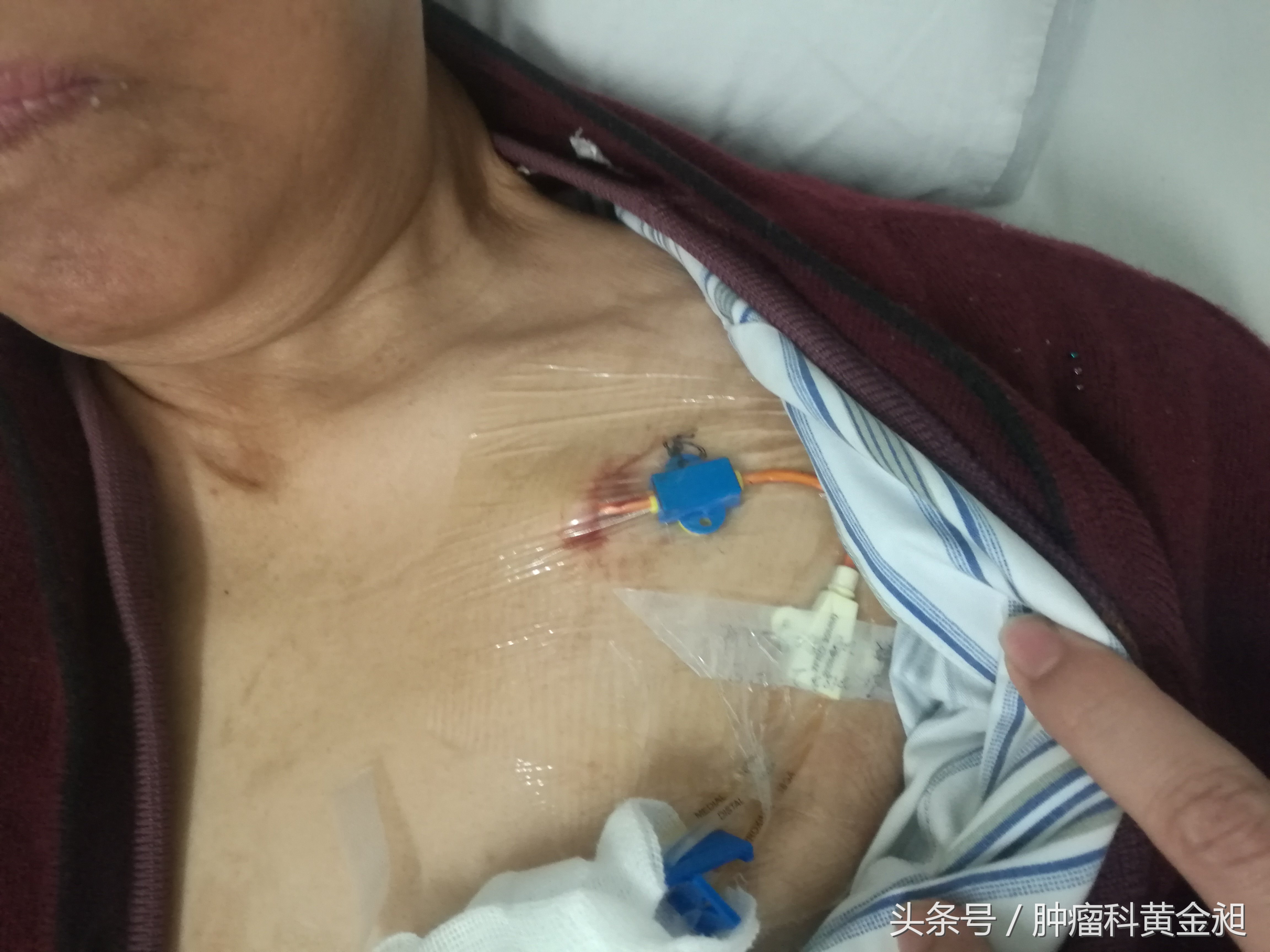 病案分享:中西医结合治疗老年卵巢癌晚期至肿瘤影像学消失1例