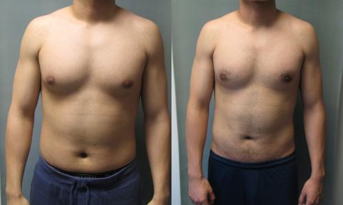 男性左乳房发育是什么原因引起的,男人胸部太大有问题吗