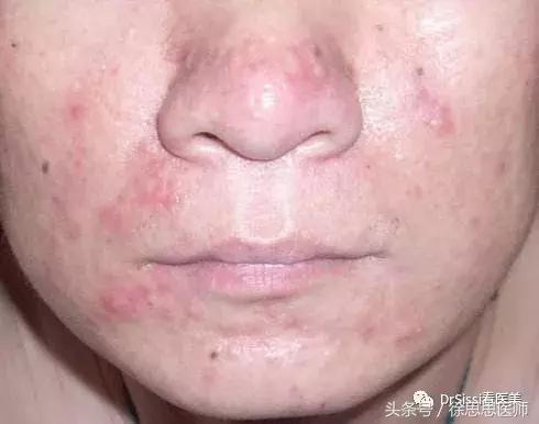 脸上80%的斑点反反复复,脸上1000多个痘坑
