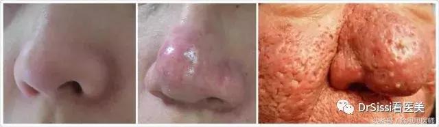 脸上80%的斑点反反复复,脸上1000多个痘坑