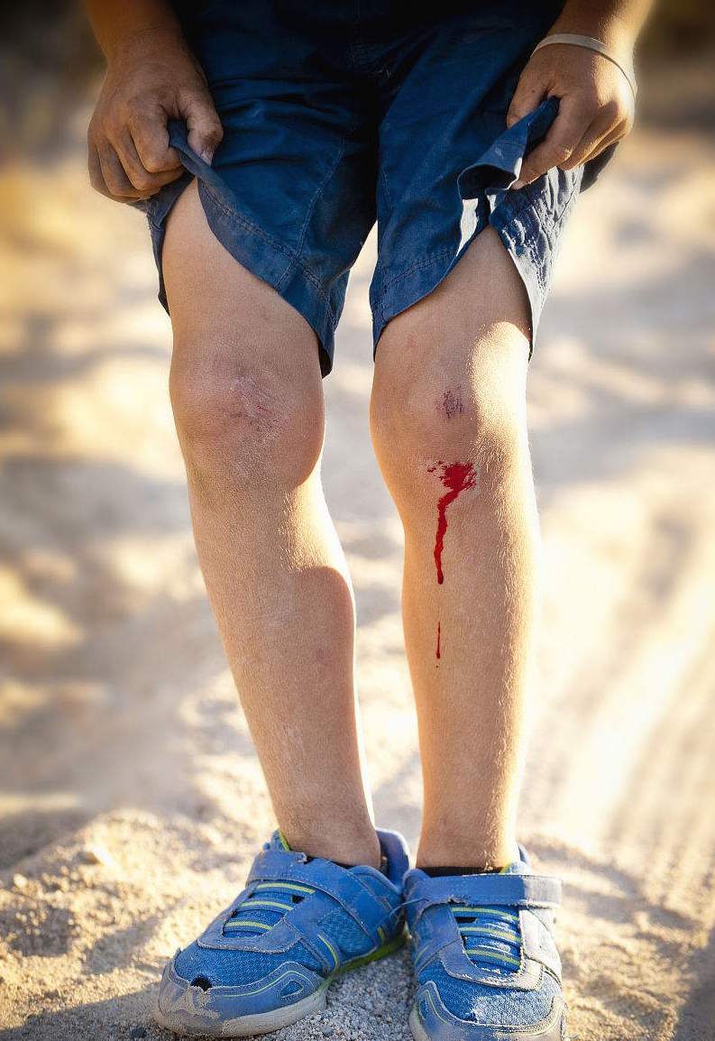 开口式伤口,开口伤口愈合过程