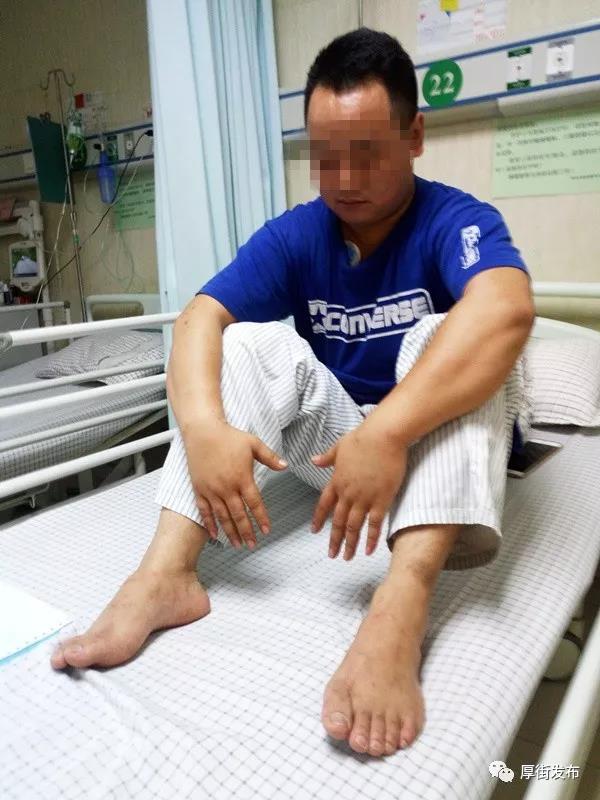 被蚂蚁咬保命,男子不慎被蚂蚁咬