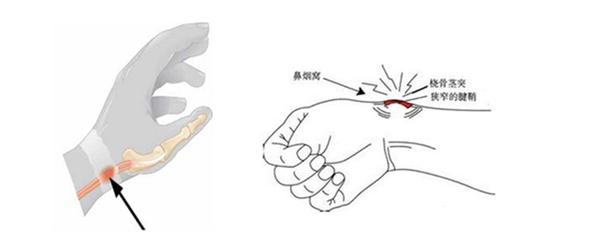 为什么新手妈妈容易得腱鞘炎,新手妈妈会遇到哪些情况