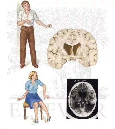 3d打印的肾移植案例,肾移植手术3d