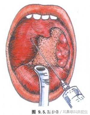 肛周脓肿早期b超能诊断吗,肛周脓肿诊断标准