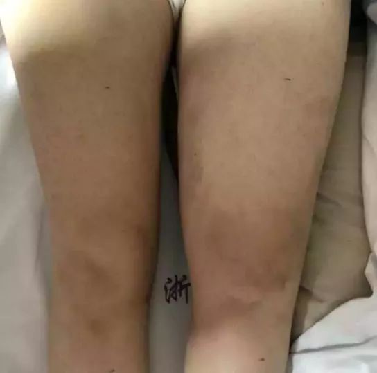 美女一条腿“暴涨”还发红发烫，只因吃了……姑娘们千万别为“大姨妈”乱吃这种药！