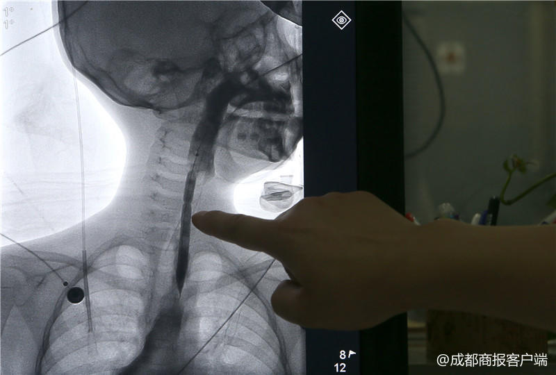 误食强碱灼伤食道后续,误食强碱灼伤食道的后果