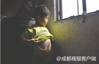 误食强碱灼伤食道后续,误食强碱灼伤食道的后果