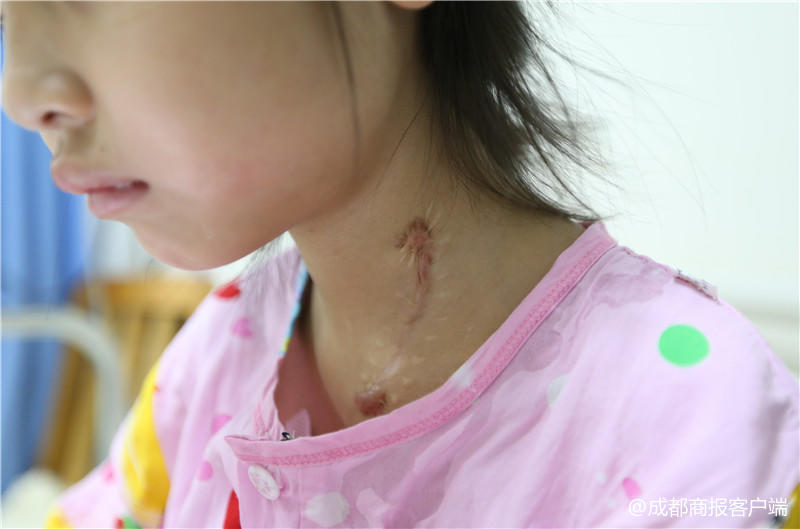 误食强碱灼伤食道后续,误食强碱灼伤食道的后果