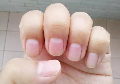 半月痕越来越少怎么回事,半月痕过多是什么情况