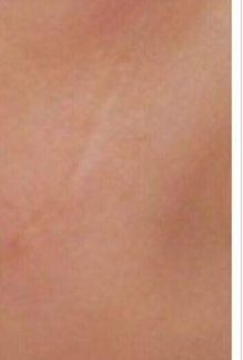 整形术后不冰敷,整形疤痕多久可以恢复