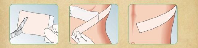 疤痕整形术后恢复过程,疤痕整形手术全过程图示