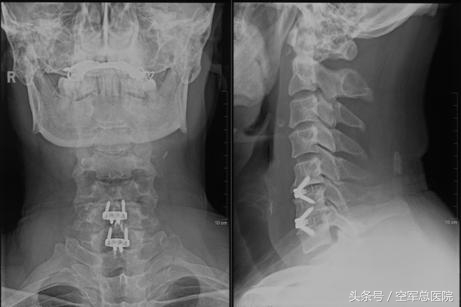 空军总医院骨科怎么样,北京军区总医院骨科治颈椎病