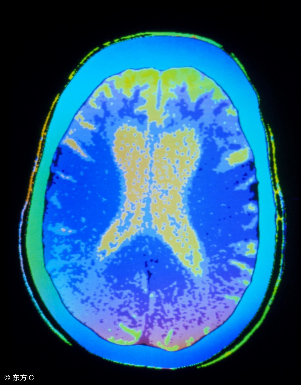 脑萎缩的护理措施,脑萎缩的正确护理方法