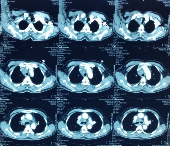 抗核治疗后反而病情加重？这个病例太经典了！
