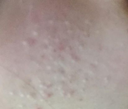 红蓝光祛痘可以永久祛痘吗,红蓝光祛痘印效果最好