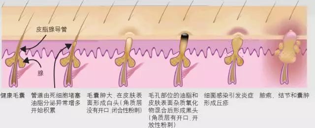 长闭口的正确消除方法,长闭口的正确消除方法新手入门