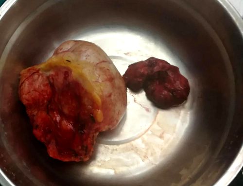 纵隔肿瘤侵犯食管是良性的吗,纵隔恶性肿瘤没转移能治愈吗