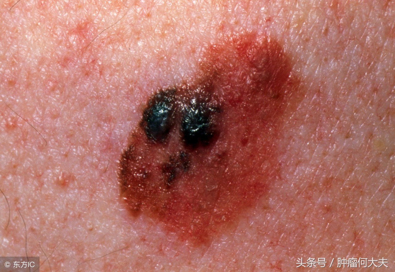 皮肤上长黑色素痣恶性图片,正常的黑痣和黑色素瘤有什么区别